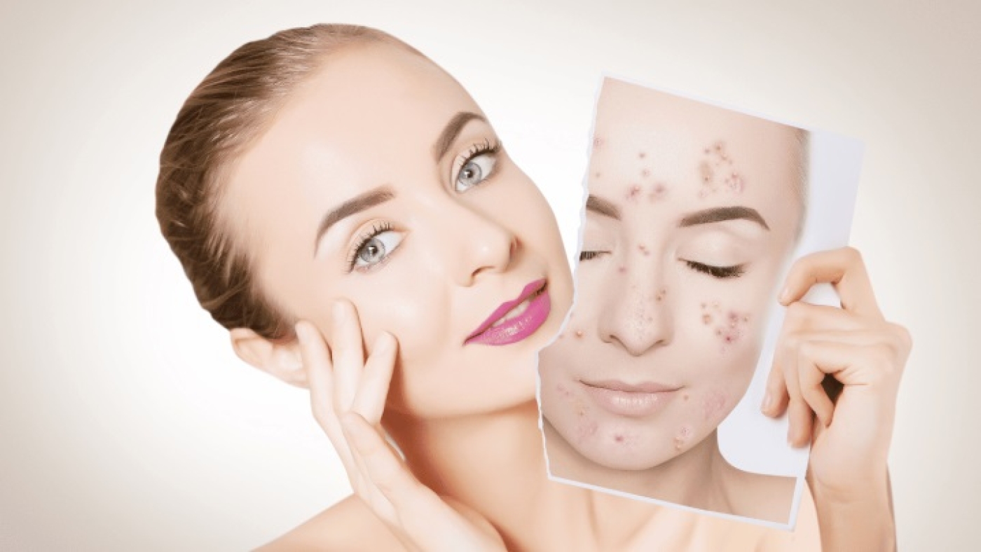 acne-r00al5y1yguhxvgtjor0k6h9v5jzx64thizmk1d2ko-i67a9b7a752a45.jpg